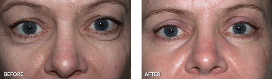 Patient's eye area before and after CO2 laser resurfacing