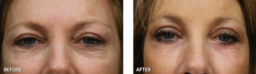 Patient's eye area before and after CO2 laser resurfacing