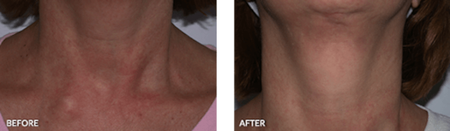 Patient's redness on neck before and after IPL