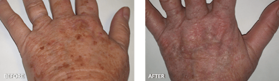 Patient's hand before and after IPL