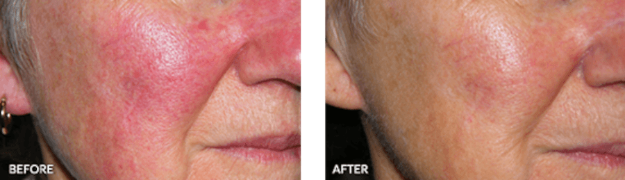 Patient's facial redness before and after IPL