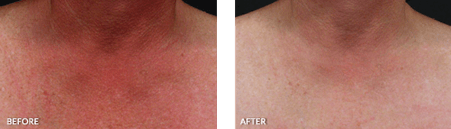 Patient's décolletage before and after IPL