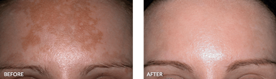 Patient's pigmentation before and after IPL