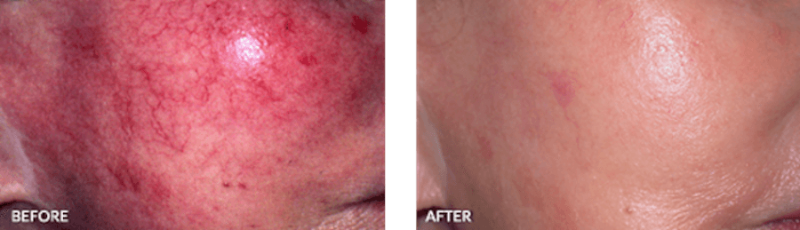 Patient's facial capillaries/blood vessels before and after IPL therapy