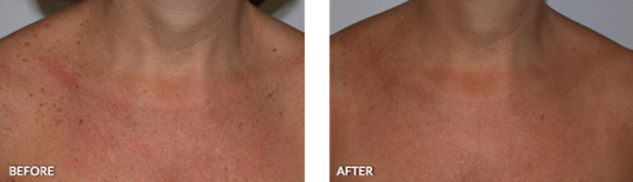 Patient's décolletage before and after IPL therapy