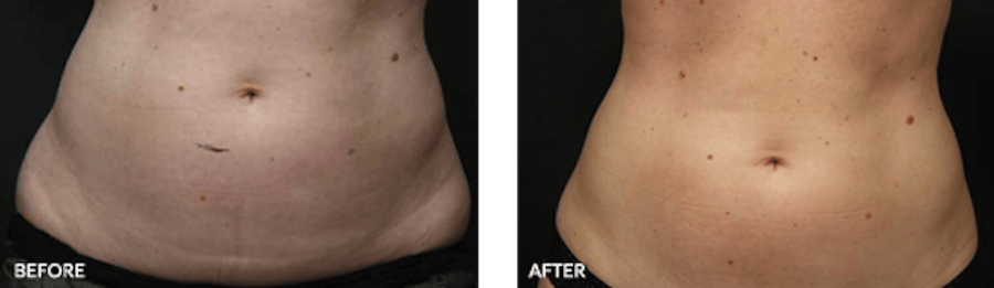 Patient's stomach before and after Liposonix