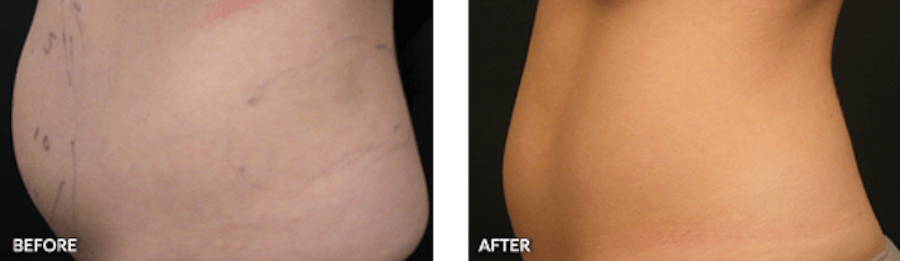 Patient's stomach before and after Liposonix
