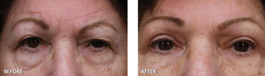 Patient's eyes before and after eyelid surgery