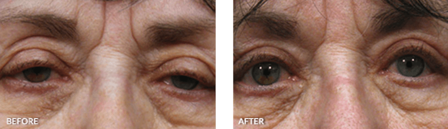Patient's eyes before and after eyelid surgery