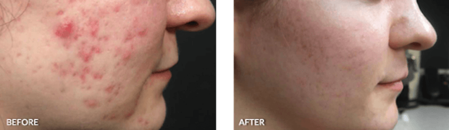 Patient's acne before and after medical skin care