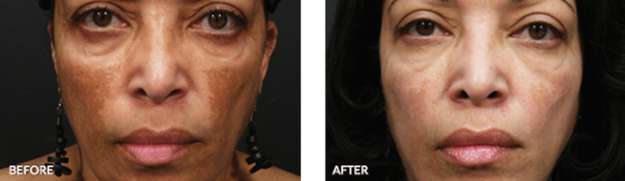 Patient before and after medical skin care