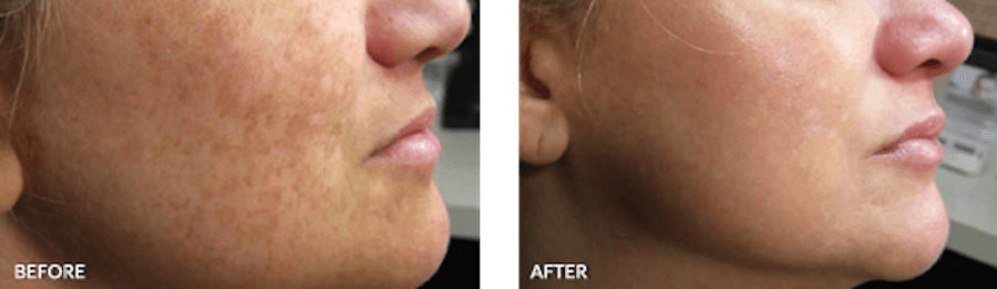 Patient before and after skin care