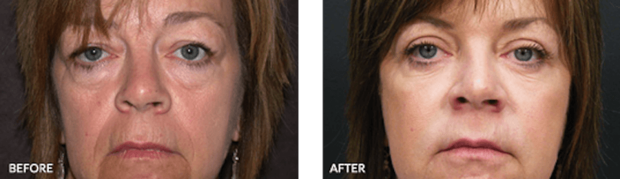 Patient's face before and after Thermage