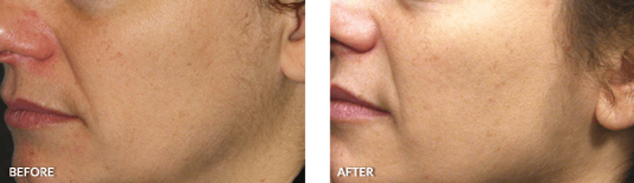 Patient's skin before and after Thermage