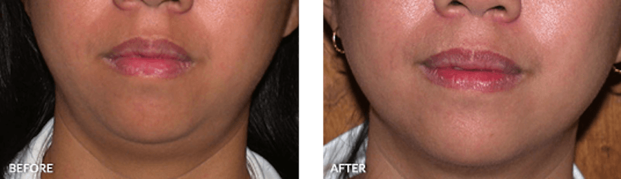 Patient's chin before and after Thermage
