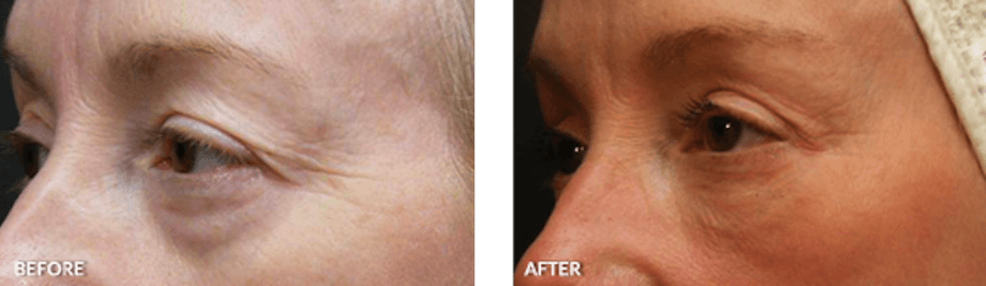 Patient's eye wrinkles before and after Thermage