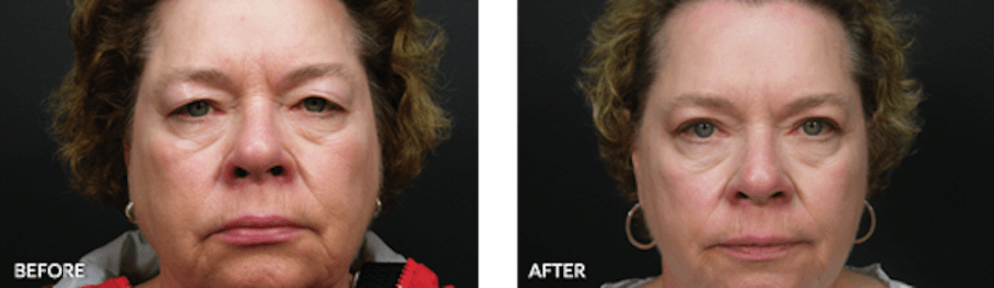 Patient's facial wrinkles before and after Thermage