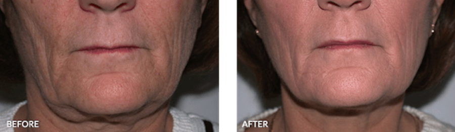 Patient's chin/neck before and after Thermage
