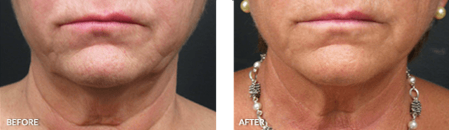 Woman's chin before and after Thermage