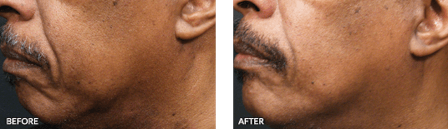 Patient's jawline and chin before and after Thermage