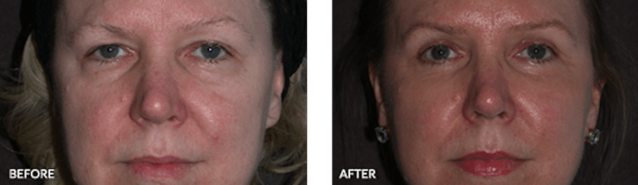 Patient before and after eyelid surgery and Thermage