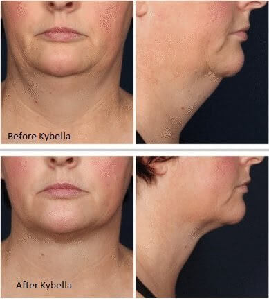 kybella before and after annapolis md