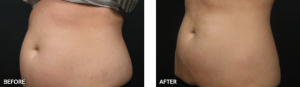 thumbs_CL1-Before-After-Liposonix-1
