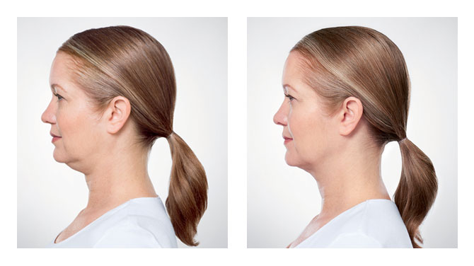 Woman before and after Kybella