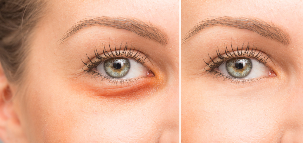 Woman's eyes with and without dark under-eye circles