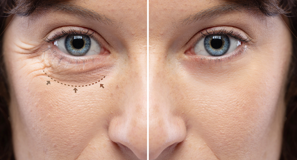 Example of a patient's under-eye area before and after blepharoplasty